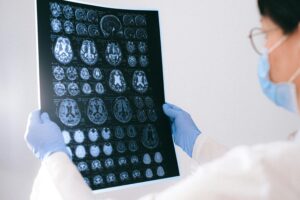 alzheimers xrays