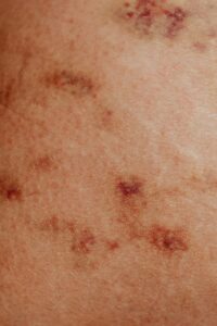 psoriasis lesions