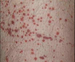 ITP purpura