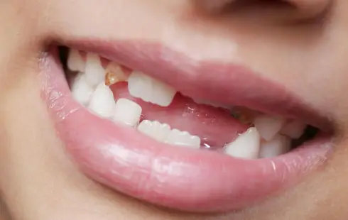 Malocclusion bite