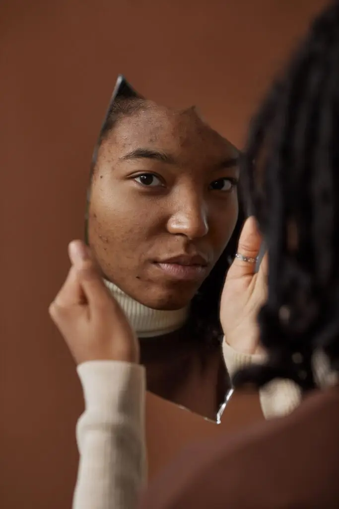 Acne young African American woman